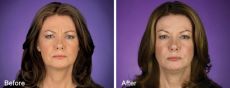 128-8 Before and After BOTOX Cosmetic