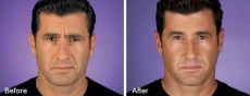 129-8 Before and After BOTOX Cosmetic