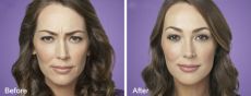 130-8 Before and After BOTOX Cosmetic