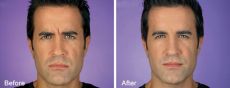 131-8 Before and After BOTOX Cosmetic