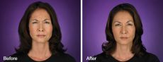 132-8 Before and After BOTOX Cosmetic