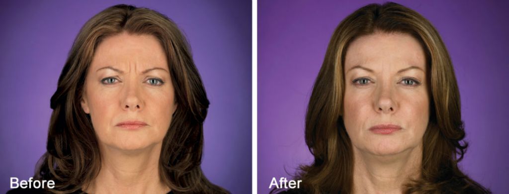 Before and After BOTOX Cosmetic