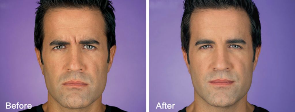 Before and After BOTOX Cosmetic